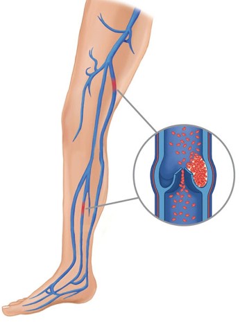 The reasons for varicose veins(1)
