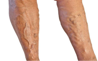 Treatment of varicose veins in legs.