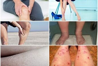 Symptoms of varicose veins on the legs