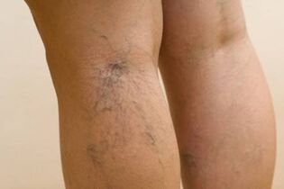 clear signs of varicose veins