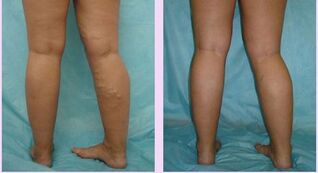how varicose veins of the first stage appear