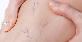 the first signs of varicose veins