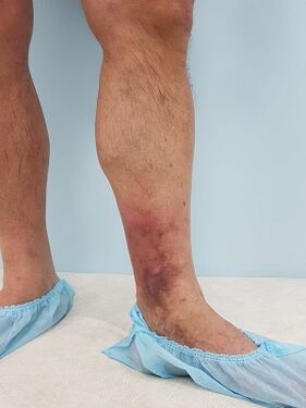 complications of varicose veins in men