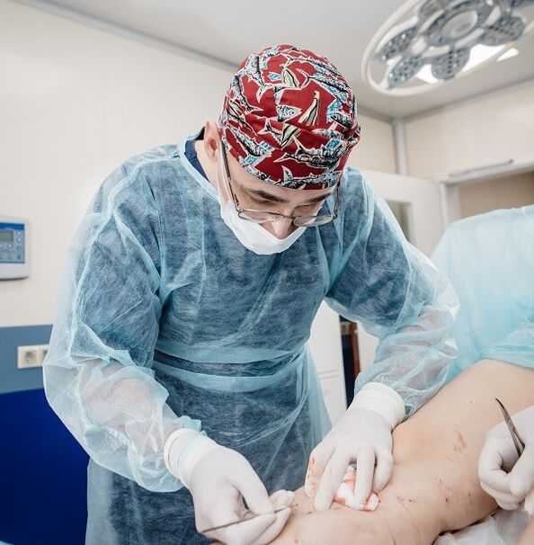 surgical treatment of varicose veins