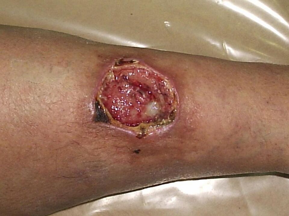 trophic ulcer with advanced varicose veins