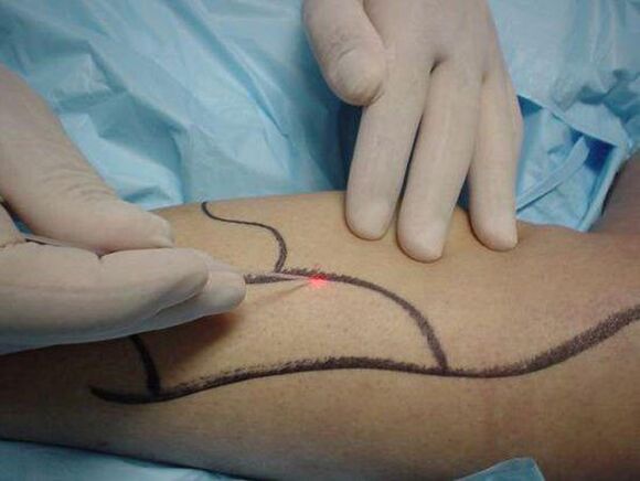 laser treatment for varicose veins