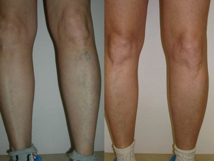 legs before and after laser treatment for varicose veins