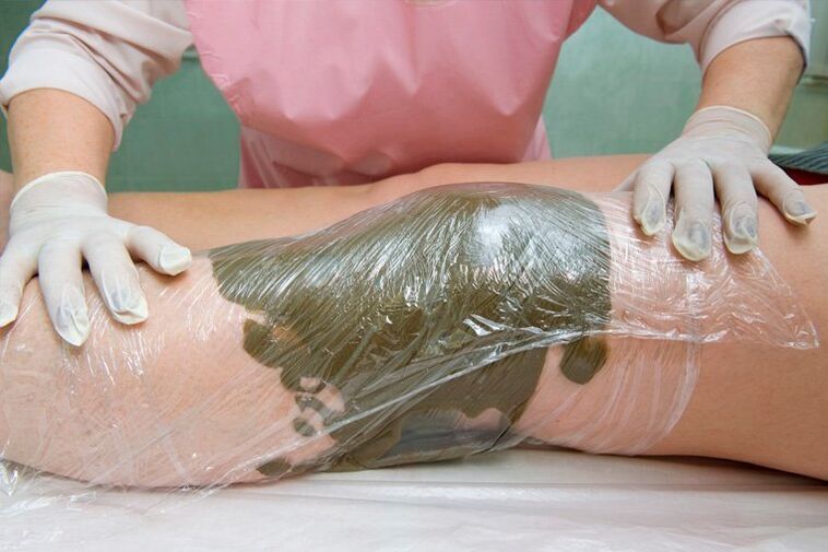 clay wraps for varicose veins