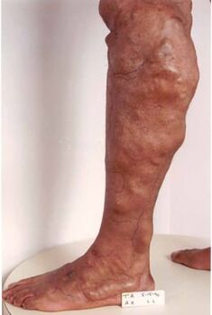 Manifestations of chronic venous insufficiency of the lower limb