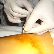 Miniphlebectomy is the most aesthetic treatment for varicose veins