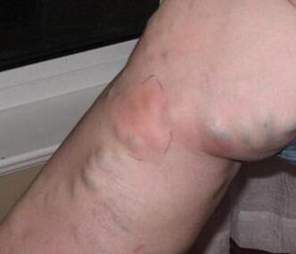 Thrombophlebitis on the leg with varicose veins