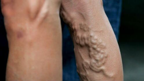 Manifestations of advanced varicose veins of the lower limbs
