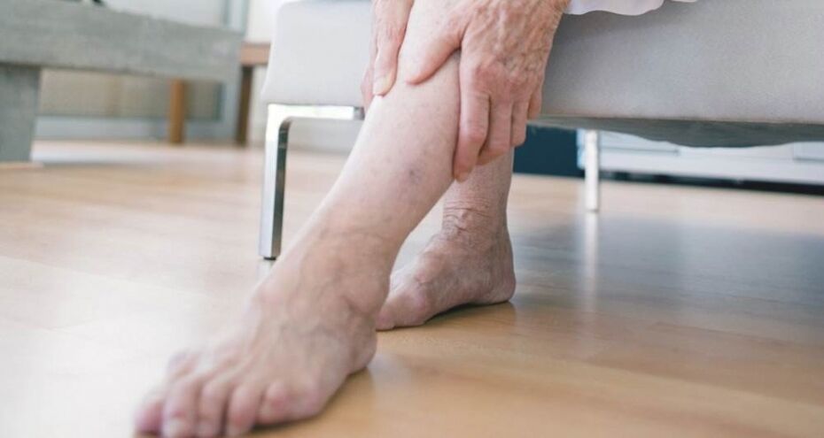 Varicose veins of the lower limbs caused by venous valve dysfunction