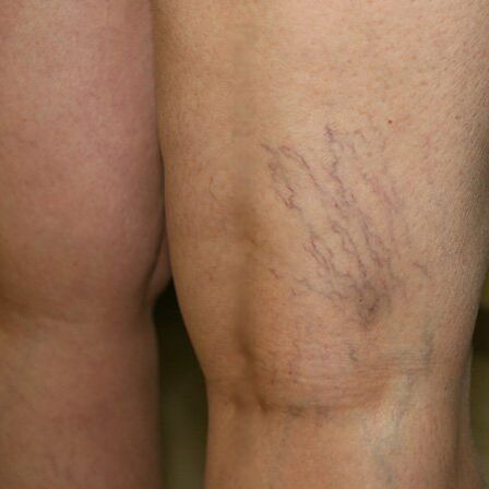 A venous mesh on the lower extremities is a sign of varicose veins