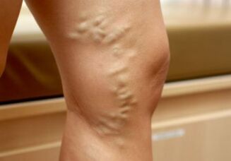 Varises on a woman's legs