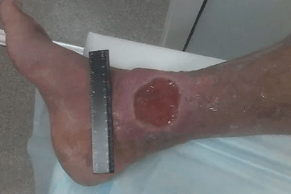 Varicose complications
