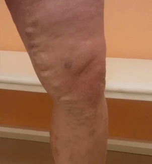 varicose veins