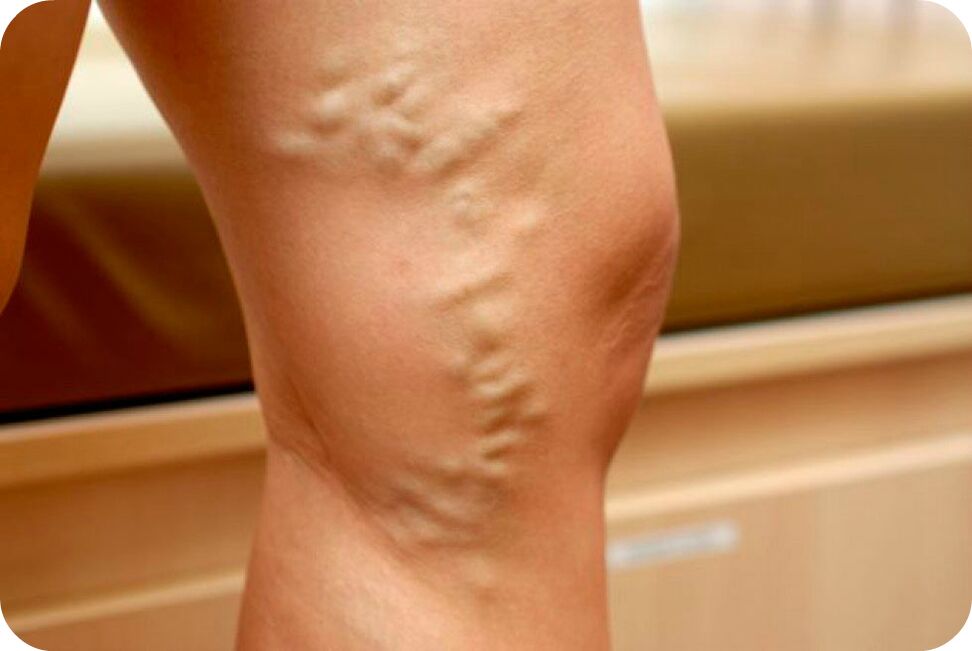 Varices of veins