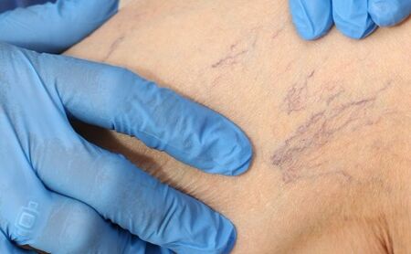 Varicose symptoms