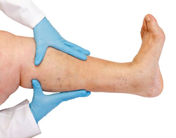 Varices on the legs