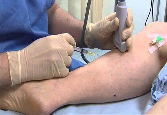 Varice treatment