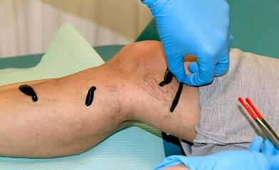 Hirudotherapy for varicose veins