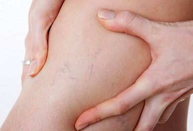 Prohibited actions for varicose veins