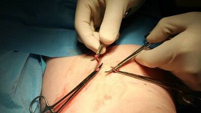 Flencitomy for varicose veins