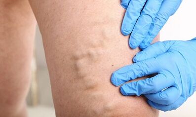 Varices on the legs