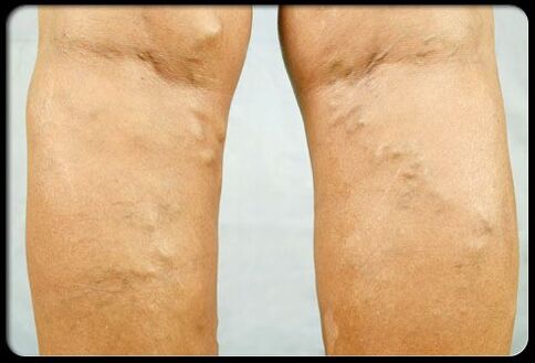 Varices on the legs