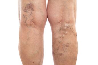 varicose veins of the lower limbs