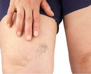 1 the stages of varicose veins