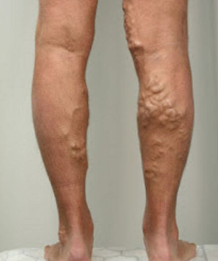 3 stages of varicose veins