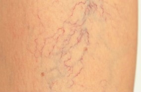 In the initial stage of varicose veins
