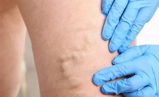 Treatment of varicose veins using the bioadhesive