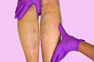 Large varicose veins